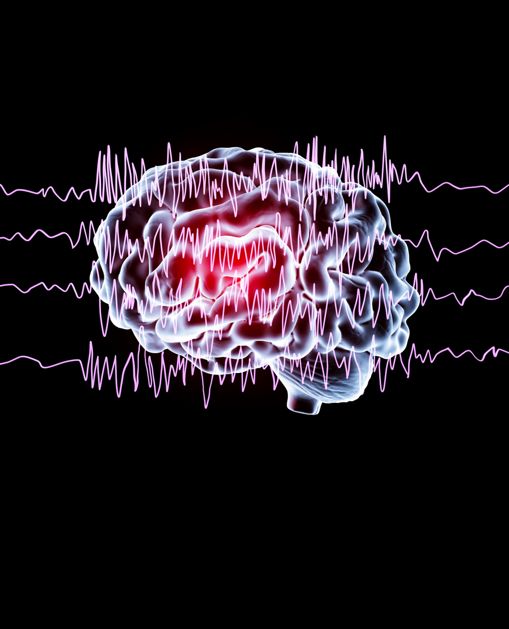 L’epilessia secondaria a encefalite autoimmune può cronicizzare se non si interviene per tempo